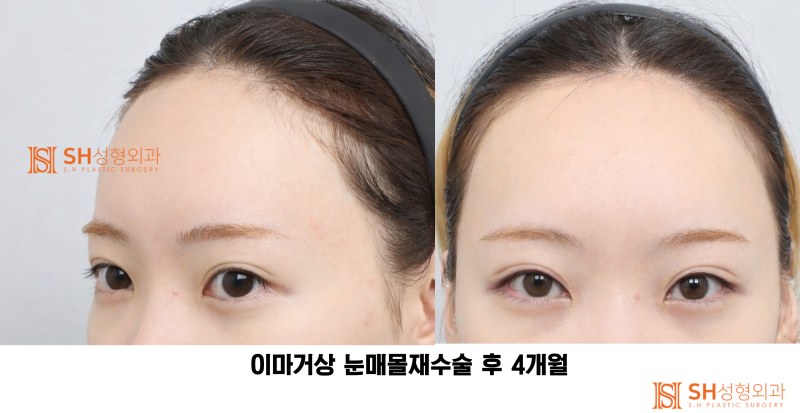 #30 If your brows and eyes look too close together? When endoscopic forehead lift and revision buried double eyelid surgery are needed together SH Plastic Surgery