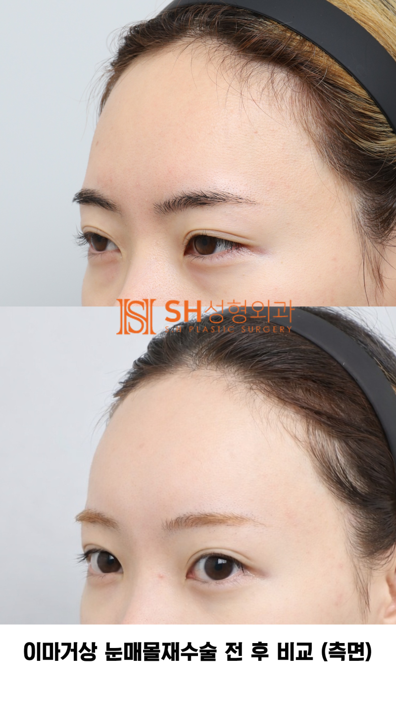 #30 If your brows and eyes look too close together? When endoscopic forehead lift and revision buried double eyelid surg