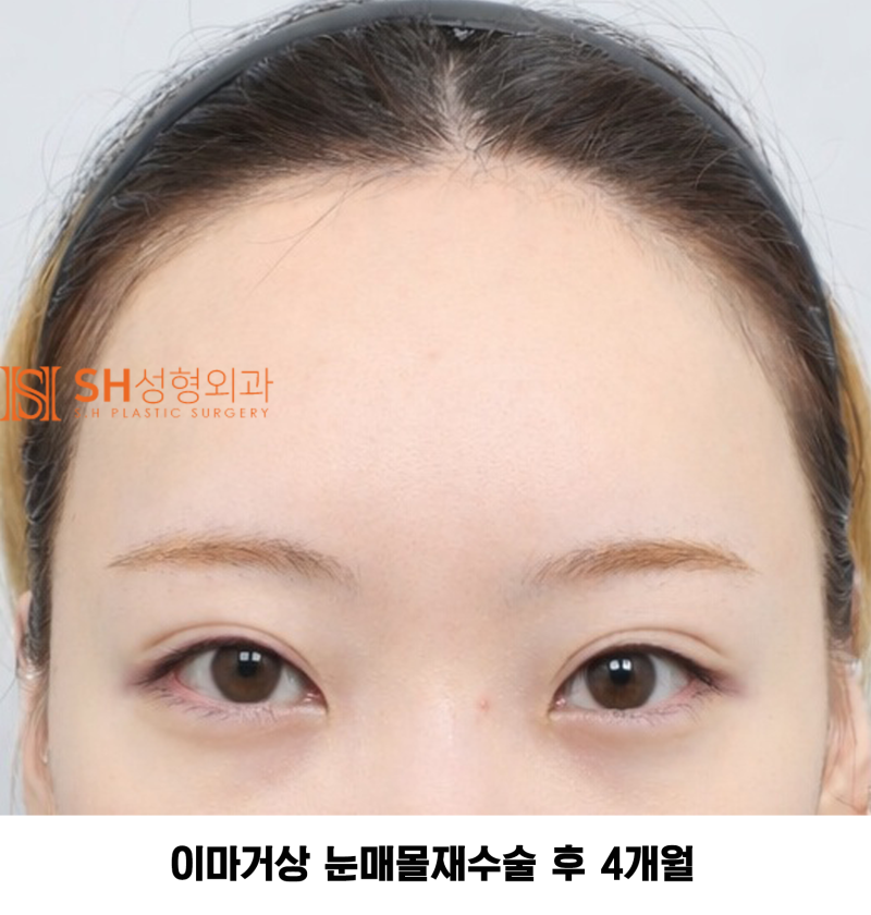 #30 If your brows and eyes look too close together? When endoscopic forehead lift and revision buried double eyelid surg