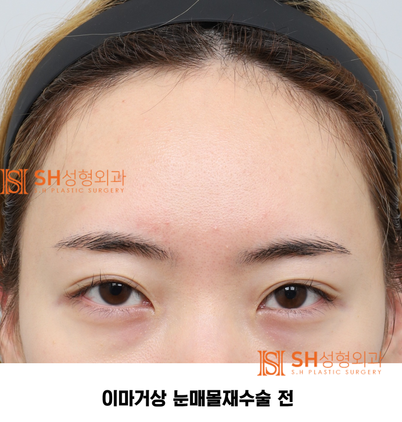 #30 If your brows and eyes look too close together? When endoscopic forehead lift and revision buried double eyelid surg