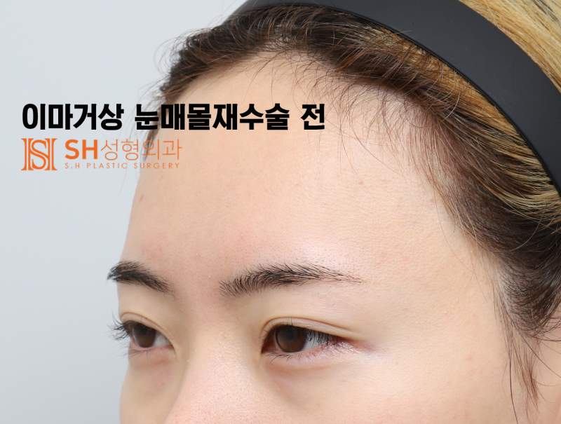 #30 If your brows and eyes look too close together? When endoscopic forehead lift and revision buried double eyelid surg