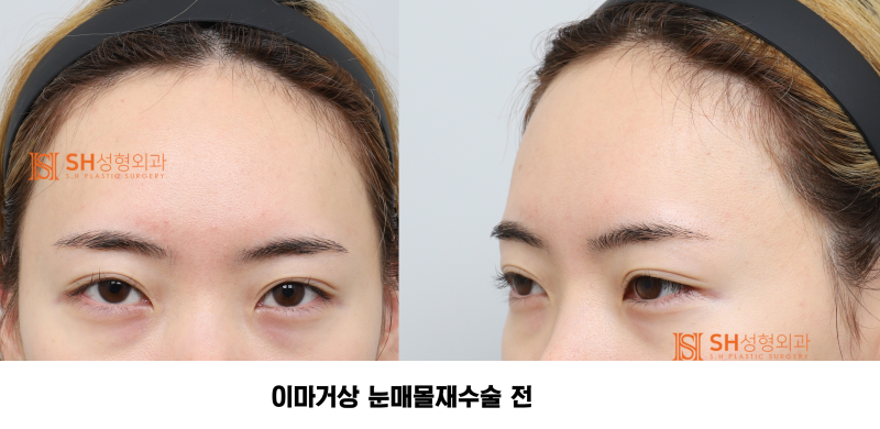 #30 If your brows and eyes look too close together? When endoscopic forehead lift and revision buried double eyelid surg