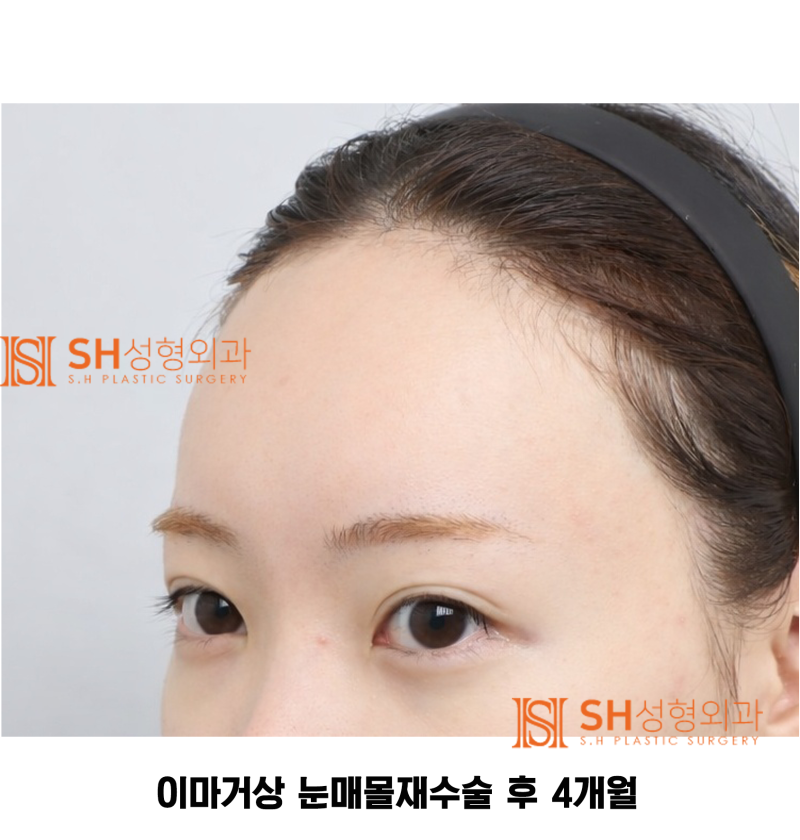 #30 If your brows and eyes look too close together? When endoscopic forehead lift and revision buried double eyelid surg