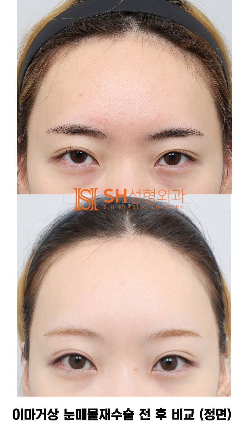 #30 If your brows and eyes look too close together? When endoscopic forehead lift and revision buried double eyelid surg