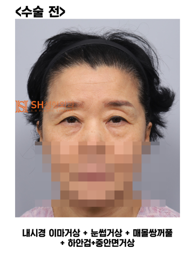 #31 Endoscopic Forehead Lift, Brow Lift, Buried Double Eyelid, Lower Blepharoplasty + Midface Lift_Why We Design the Upp