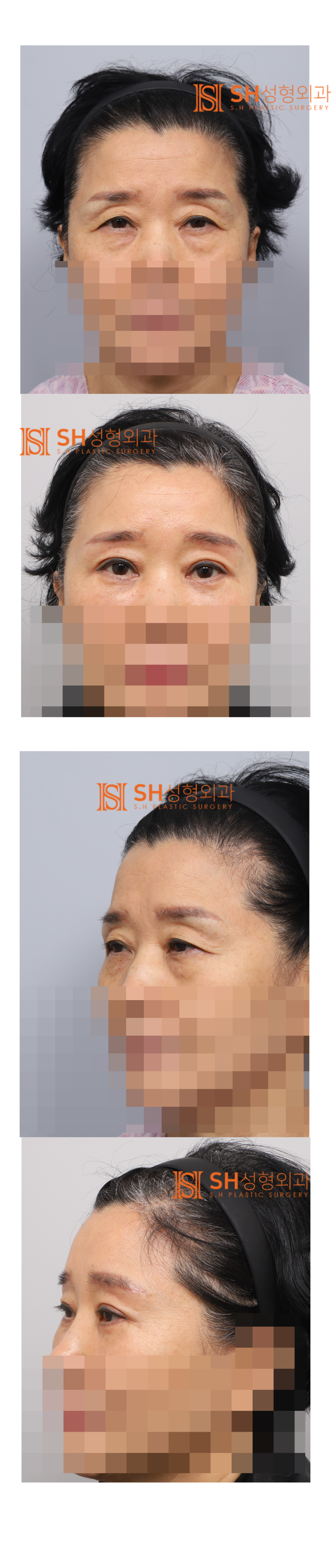#31 Endoscopic Forehead Lift, Eyebrow Lift, Buried Double Eyelid, Lower Blepharoplasty + Midface Lift_Why We Design from
