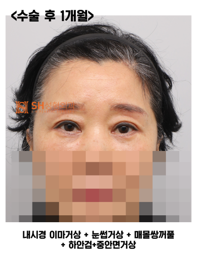 #31 Endoscopic Forehead Lift, Brow Lift, Buried Double Eyelid, Lower Blepharoplasty + Midface Lift_Why We Design the Upp