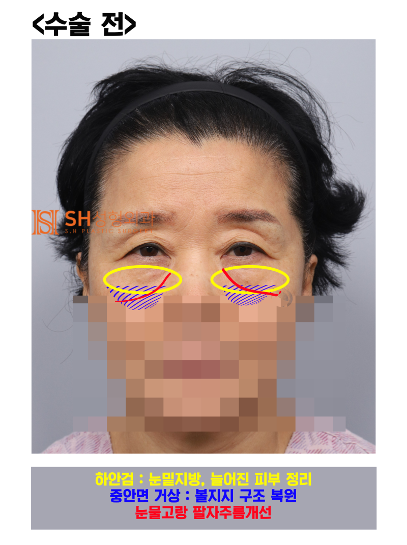 #31 Endoscopic Forehead Lift, Brow Lift, Buried Double Eyelid, Lower Blepharoplasty + Midface Lift_Why We Design the Upp