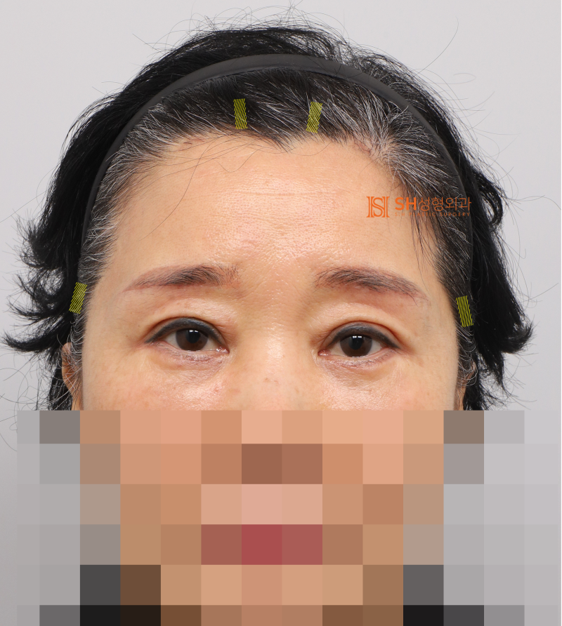 #31 Endoscopic Forehead Lift, Brow Lift, Buried Double Eyelid, Lower Blepharoplasty + Midface Lift_Why We Design the Upp