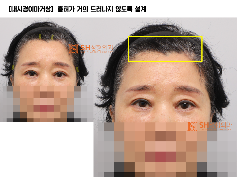 #31 Endoscopic Forehead Lift, Brow Lift, Buried Double Eyelid, Lower Blepharoplasty + Midface Lift_Why We Design the Upp