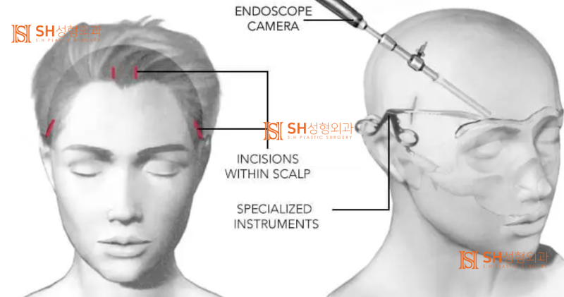 #31 Endoscopic Forehead Lift, Brow Lift, Buried Double Eyelid, Lower Blepharoplasty + Midface Lift_Why We Design the Upper to Midface as ‘One Flow’ SH Plastic Surgery