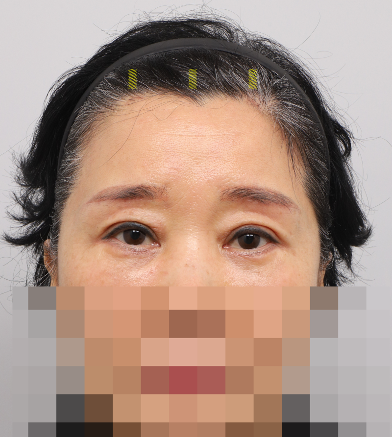 #31 Why the upper and mid-face should be designed together! Endoscopic Forehead Lift, Brow Lift, Buried Suture Double Ey