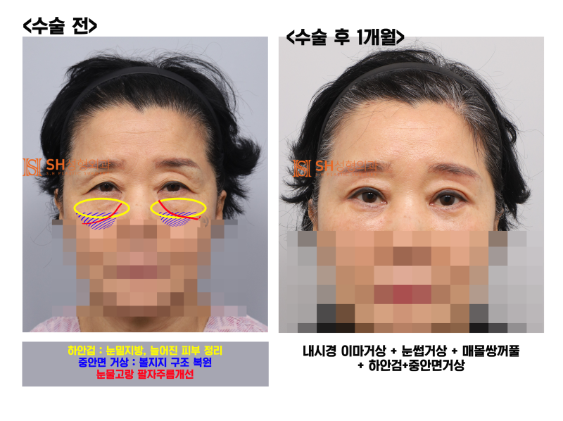 #31 Why the upper and mid-face should be designed together! Endoscopic Forehead Lift, Brow Lift, Buried Suture Double Ey