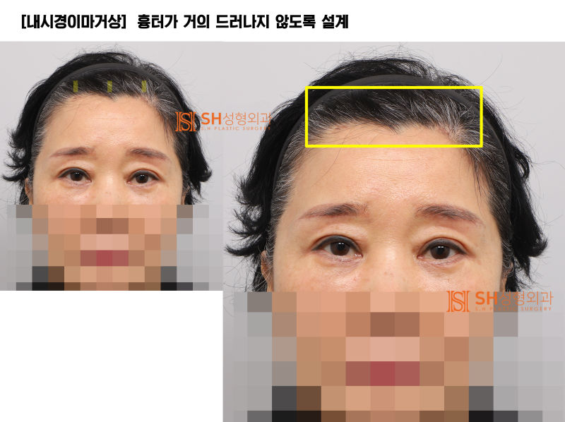 #31 Why the upper and mid-face should be designed together! Endoscopic Forehead Lift, Brow Lift, Buried Suture Double Ey