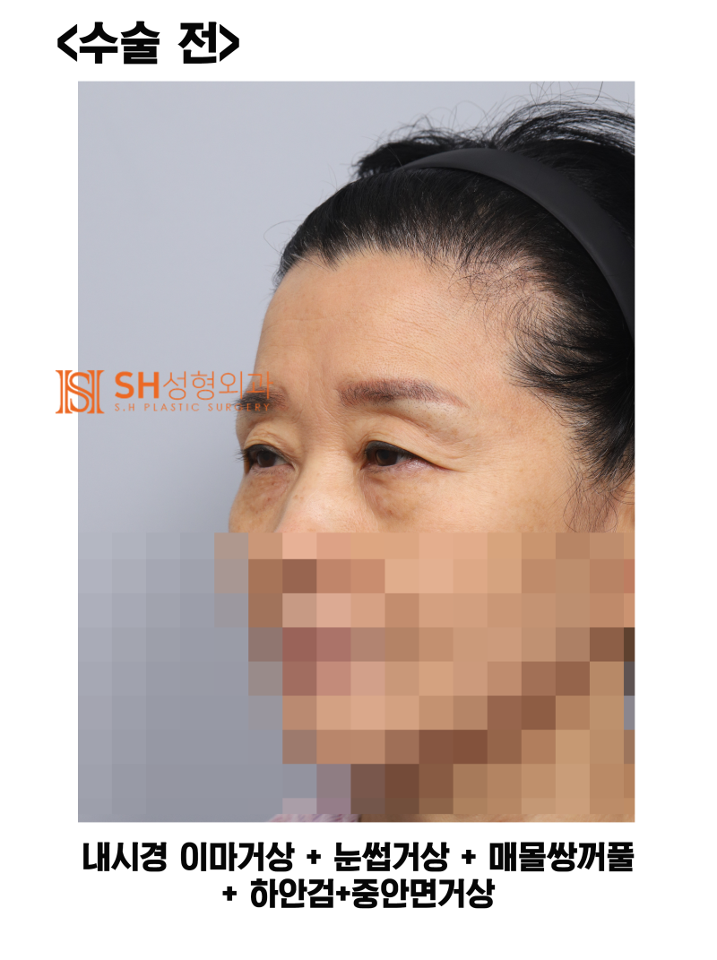 #31 Why the upper and mid-face should be designed together! Endoscopic Forehead Lift, Brow Lift, Buried Suture Double Ey