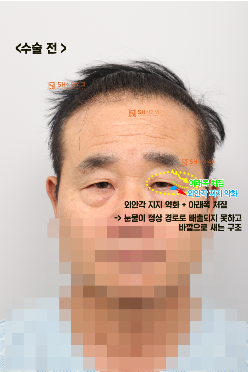 60s Male Tearing & Periorbital Sagging: Why Endotine Endoscopic Forehead Lift, Lower Blepharoplasty, Midface Lift, and S