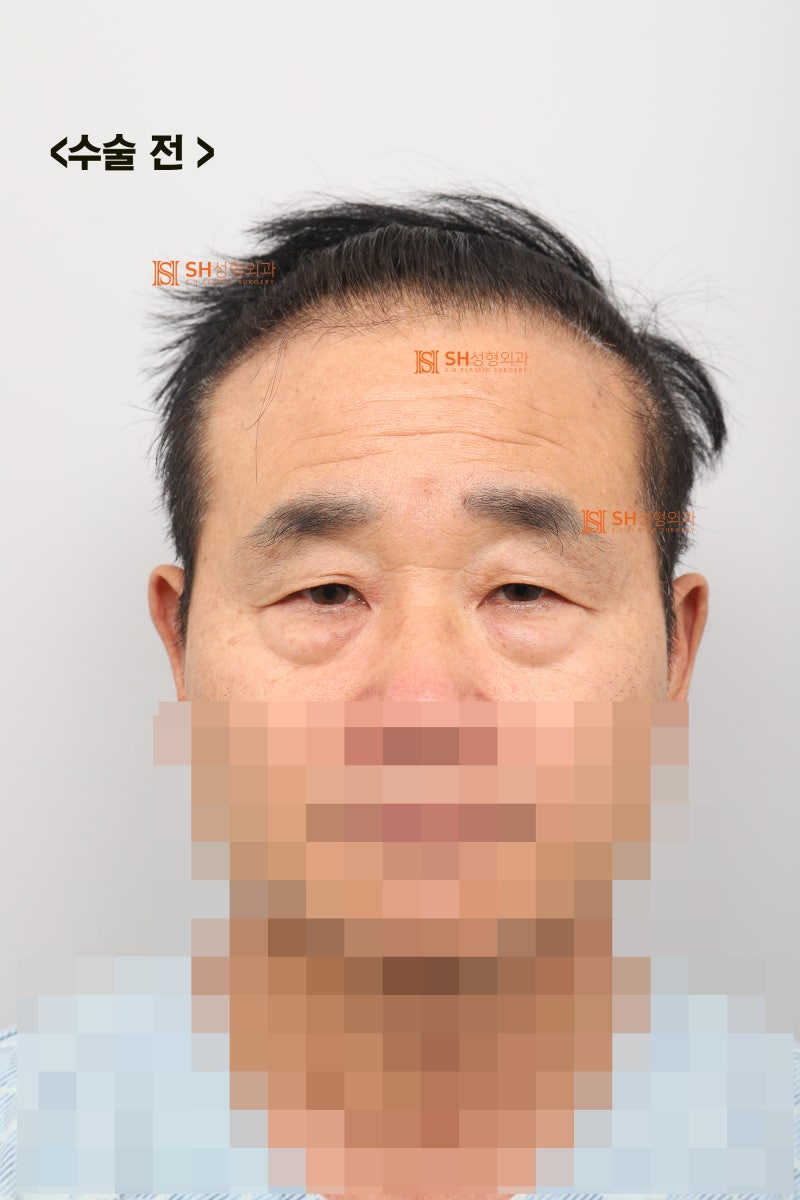 60s Male Tearing & Periorbital Sagging: Why Endotine Endoscopic Forehead Lift, Lower Blepharoplasty, Midface Lift, and S