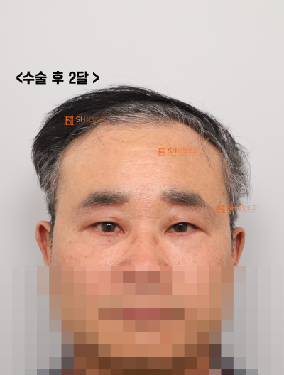 60s Male Tearing & Periorbital Sagging: Why Endotine Endoscopic Forehead Lift, Lower Blepharoplasty, Midface Lift, and S