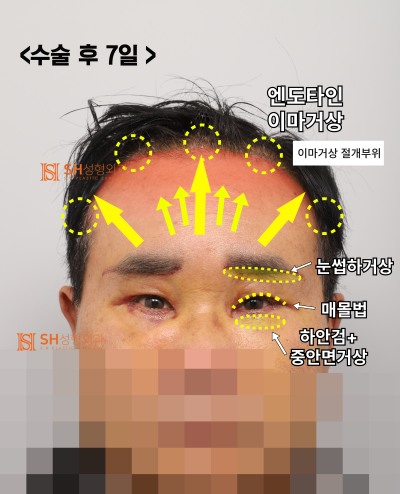 60s Male Tearing & Periorbital Sagging: Why Endotine Endoscopic Forehead Lift, Lower Blepharoplasty, Midface Lift, and S