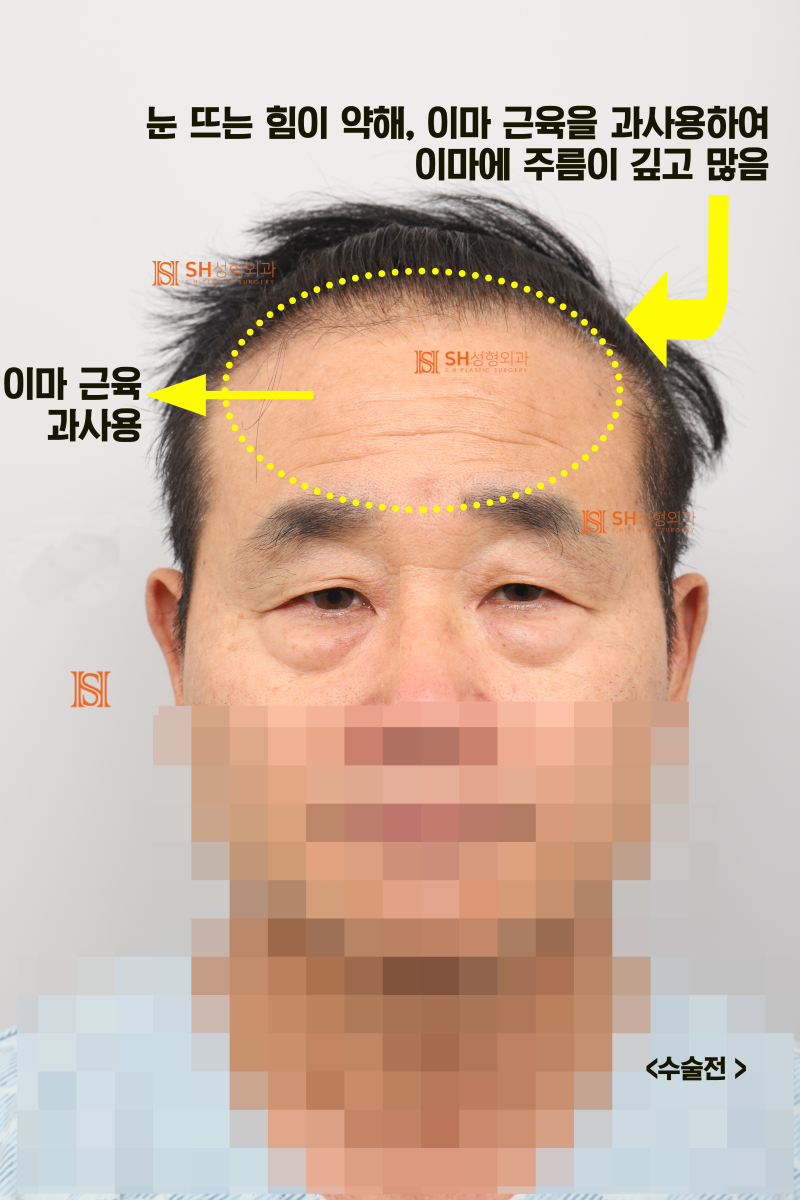 60s Male Tearing & Periorbital Sagging: Why Endotine Endoscopic Forehead Lift, Lower Blepharoplasty, Midface Lift, and S