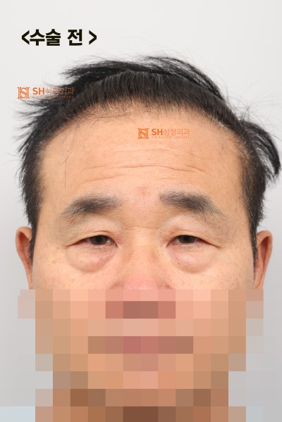 60s Male Tearing & Periorbital Sagging: Why Endotine Endoscopic Forehead Lift, Lower Blepharoplasty, Midface Lift, and S