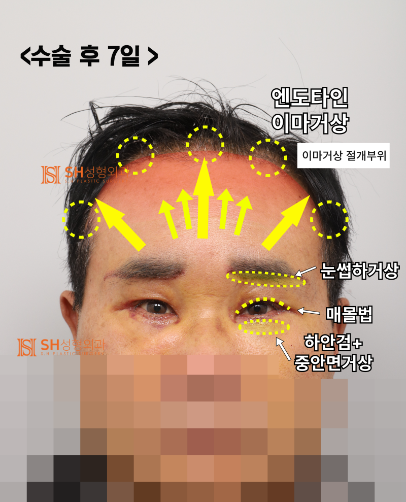 60s Male Tearing & Periorbital Sagging: Why Endotine Endoscopic Forehead Lift, Lower Blepharoplasty, Midface Lift, and S