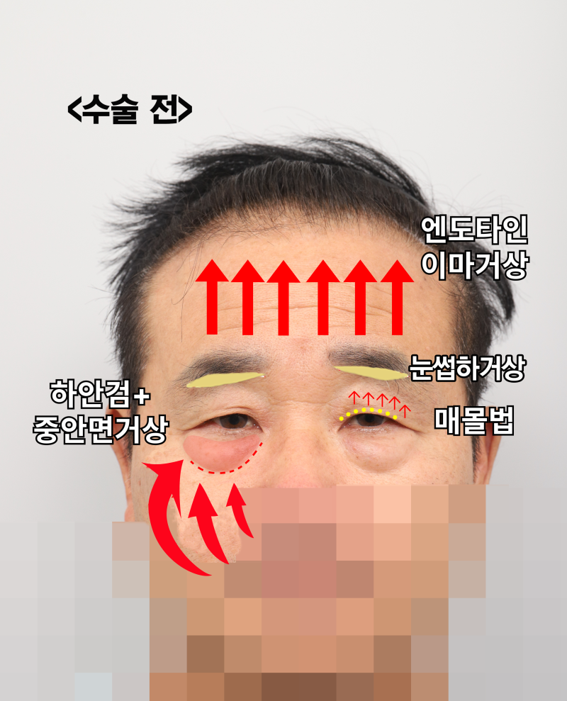 60s Male Tearing & Periorbital Sagging: Why Endotine Endoscopic Forehead Lift, Lower Blepharoplasty, Midface Lift, and S