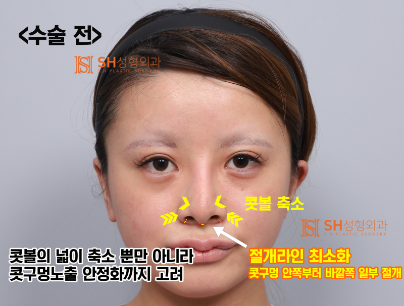Review Operasi Hidung Revisi, Jika Cuping Hidung Terlihat Lebih Lebar Setelah Operasi Hidung? Alasan Mengapa Penggantian