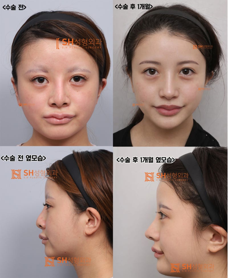 Review Operasi Hidung Revisi, Jika Cuping Hidung Terlihat Lebih Lebar Setelah Operasi Hidung? Alasan Mengapa Penggantian