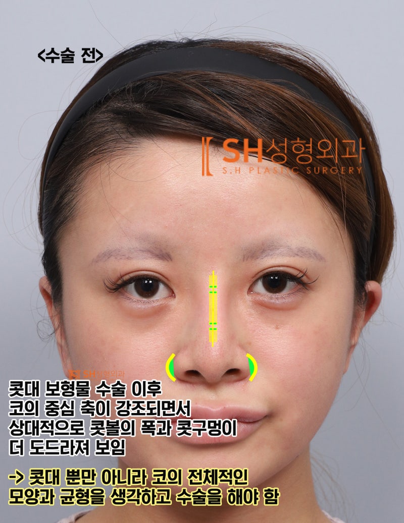 Review Operasi Hidung Revisi, Jika Cuping Hidung Terlihat Lebih Lebar Setelah Operasi Hidung? Alasan Mengapa Penggantian