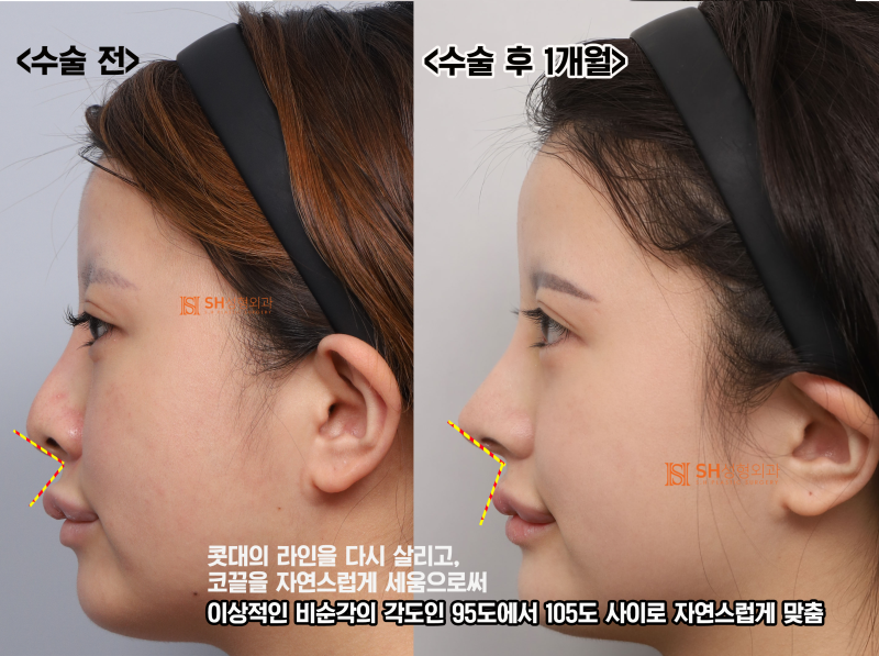 Review Operasi Hidung Revisi, Jika Cuping Hidung Terlihat Lebih Lebar Setelah Operasi Hidung? Alasan Mengapa Penggantian Silikon dan Pengecilan Cuping Hidung Diperlukan Bersama. SH Plastic Surgery