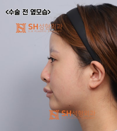 Review Operasi Hidung Revisi, Jika Cuping Hidung Terlihat Lebih Lebar Setelah Operasi Hidung? Alasan Mengapa Penggantian