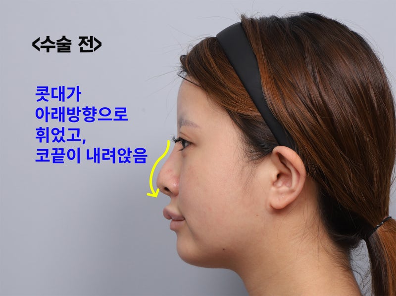 Review Operasi Hidung Revisi, Jika Cuping Hidung Terlihat Lebih Lebar Setelah Operasi Hidung? Alasan Mengapa Penggantian