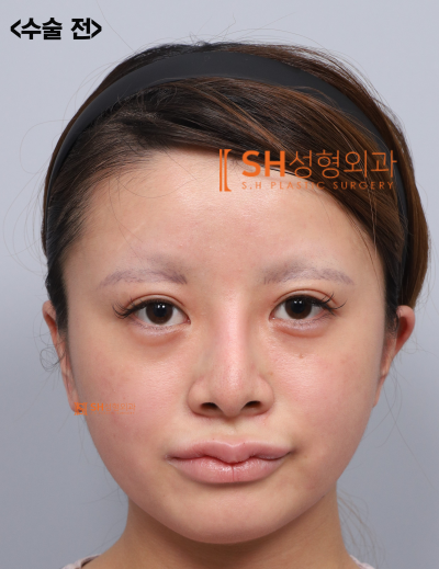 Review Operasi Hidung Revisi, Jika Cuping Hidung Terlihat Lebih Lebar Setelah Operasi Hidung? Alasan Mengapa Penggantian