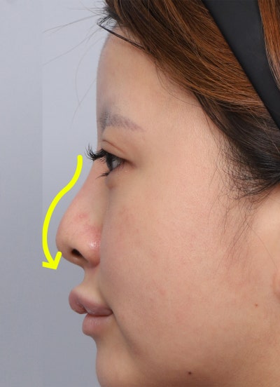 Review Operasi Hidung Revisi, Jika Cuping Hidung Terlihat Lebih Lebar Setelah Operasi Hidung? Alasan Mengapa Penggantian