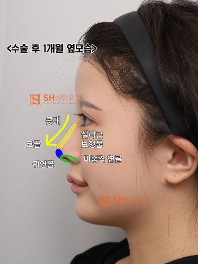 Review Operasi Hidung Revisi, Jika Cuping Hidung Terlihat Lebih Lebar Setelah Operasi Hidung? Alasan Mengapa Penggantian
