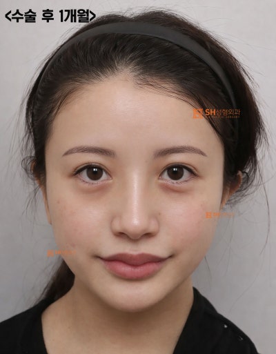 Review Operasi Hidung Revisi, Jika Cuping Hidung Terlihat Lebih Lebar Setelah Operasi Hidung? Alasan Mengapa Penggantian