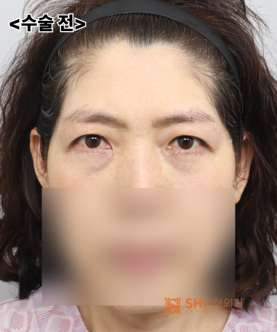 If your double eyelid line keeps collapsing, the cause might be your ‘forehead’. SH Plastic Surgery's Endotine Endoscopi
