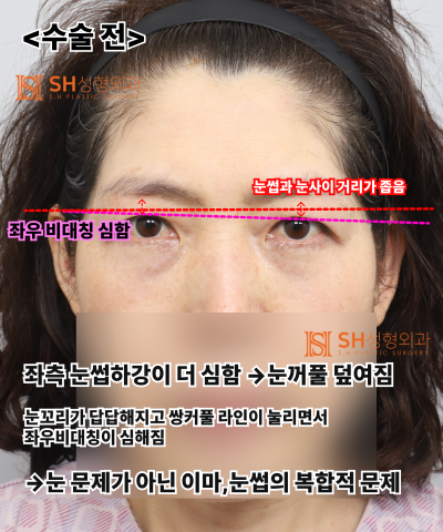 If your double eyelid line keeps collapsing, the cause might be your ‘forehead’. SH Plastic Surgery's Endotine Endoscopi