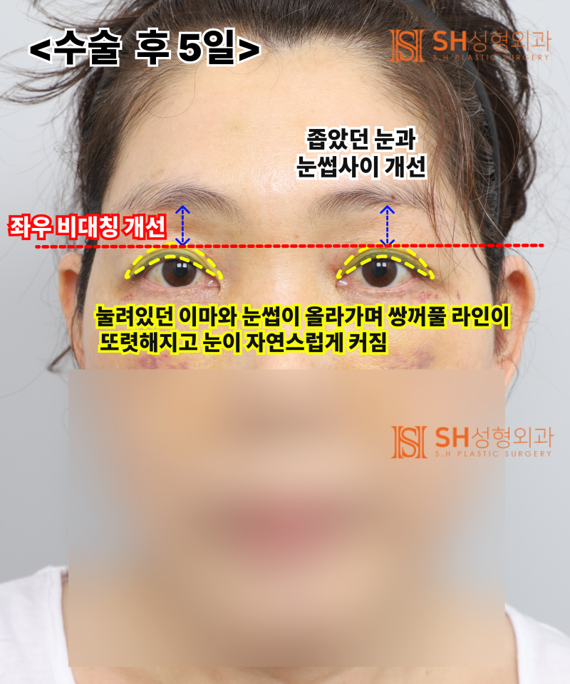 If your double eyelid line keeps collapsing, the cause might be your ‘forehead’. SH Plastic Surgery's Endotine Endoscopi