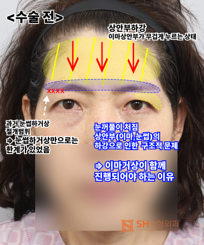 If your double eyelid line keeps collapsing, the cause might be your ‘forehead’. SH Plastic Surgery's Endotine Endoscopi