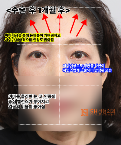 If your double eyelid line keeps collapsing, the cause might be your ‘forehead’. SH Plastic Surgery's Endotine Endoscopi