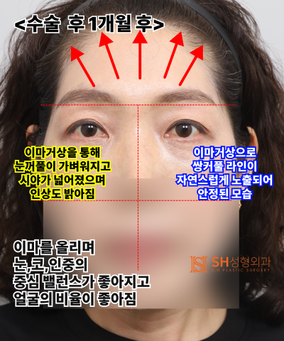 If your double eyelid line keeps collapsing, the cause might be your ‘forehead’. SH Plastic Surgery's Endotine Endoscopi
