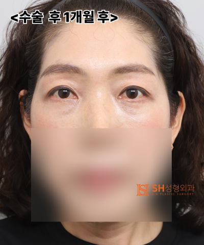 Jika Garis Kelopak Mata Ganda Anda Terus Rusak, Penyebabnya Mungkin ‘Dahi’. SH Plastic Surgery Endotine Endoscopic Foreh