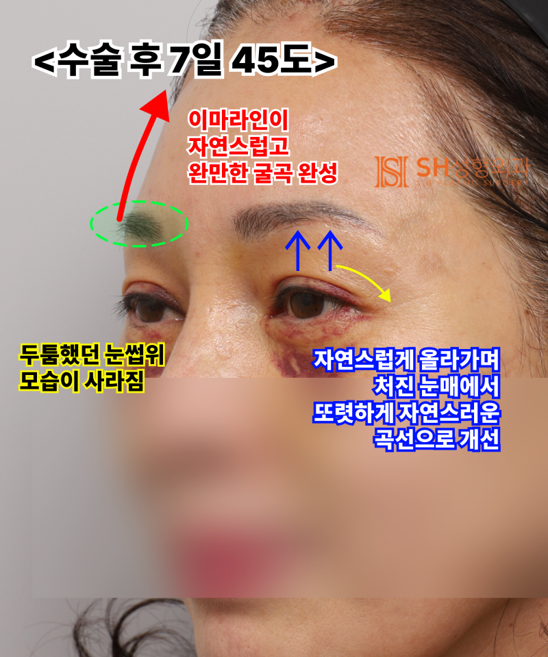 Kelopak mata kendur usia 51 tahun, mengapa diatasi dengan Endotine Forehead Lift daripada incisional double eyelid? | Ka