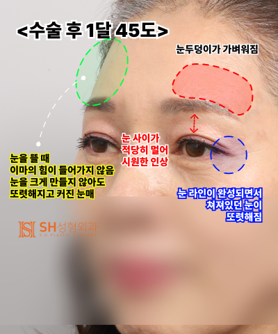Kelopak mata kendur usia 51 tahun, mengapa diatasi dengan Endotine Forehead Lift daripada incisional double eyelid? | Ka