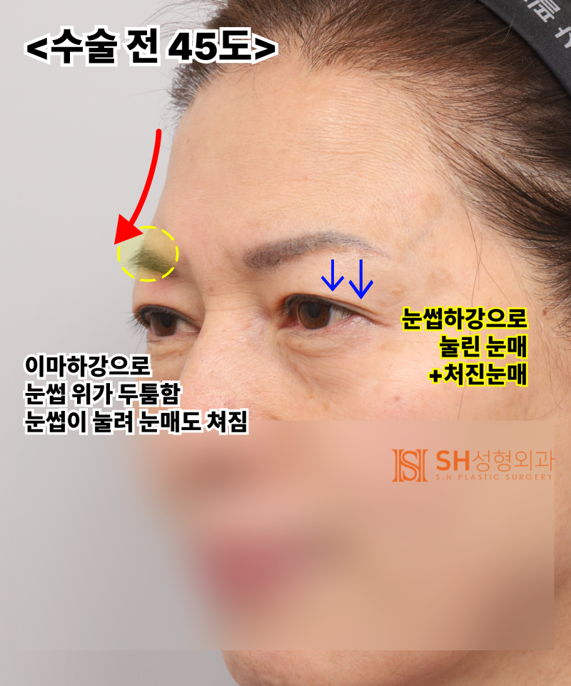 Kelopak mata kendur usia 51 tahun, mengapa diatasi dengan Endotine Forehead Lift daripada incisional double eyelid? | Ka