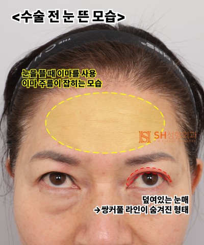 Kelopak mata kendur usia 51 tahun, mengapa diatasi dengan Endotine Forehead Lift daripada incisional double eyelid? | Ka