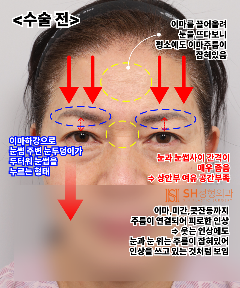 Kelopak mata kendur usia 51 tahun, mengapa diatasi dengan Endotine Forehead Lift daripada incisional double eyelid? | Ka