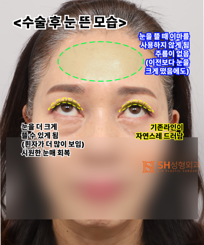 Kelopak mata kendur usia 51 tahun, mengapa diatasi dengan Endotine Forehead Lift daripada incisional double eyelid? | Ka